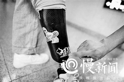 伤员在假肢上贴卡通画 伤员在假肢上贴卡通画